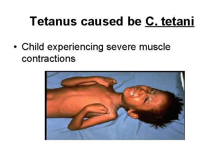 Tetanus caused be C. tetani • Child experiencing severe muscle contractions 