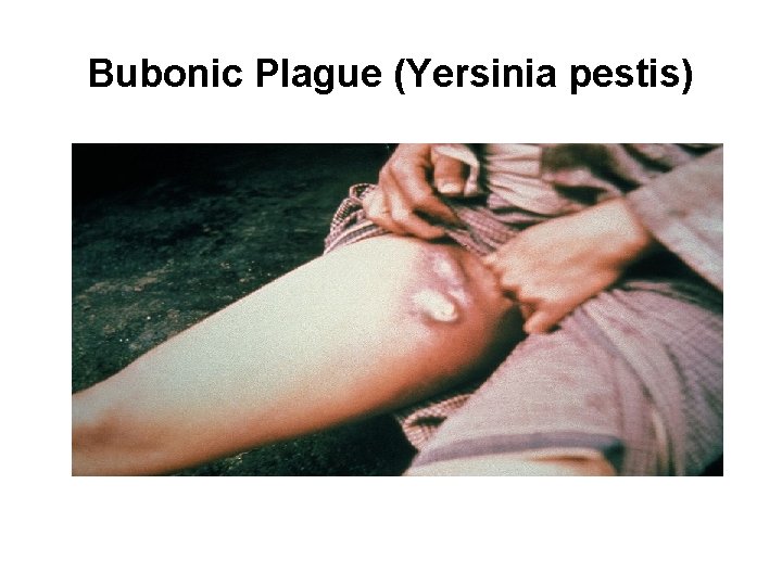 Bubonic Plague (Yersinia pestis) 