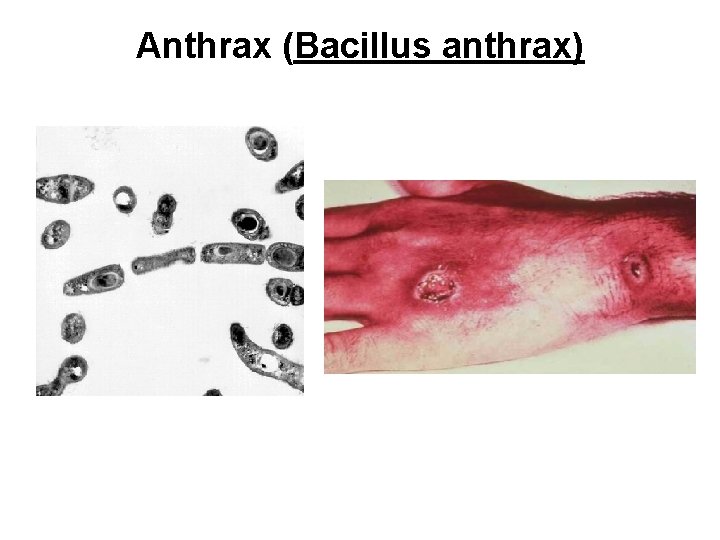 Anthrax (Bacillus anthrax) 