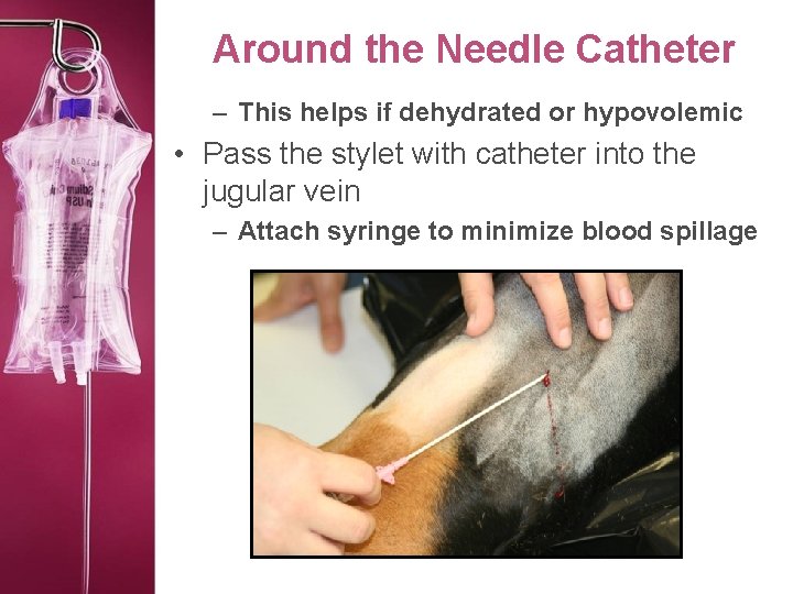 Around the Needle Catheter – This helps if dehydrated or hypovolemic • Pass the