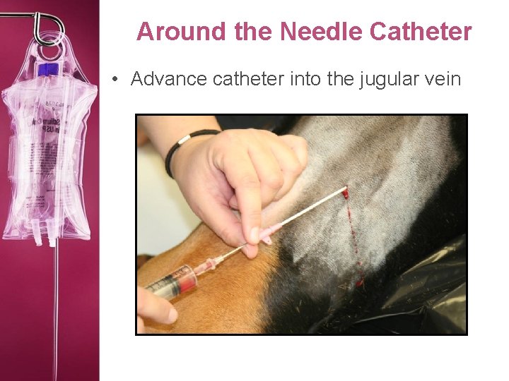 Around the Needle Catheter • Advance catheter into the jugular vein 