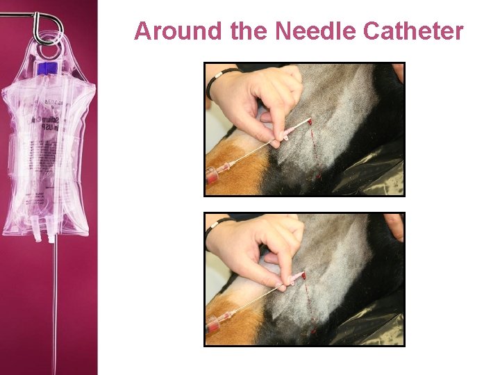 Around the Needle Catheter 