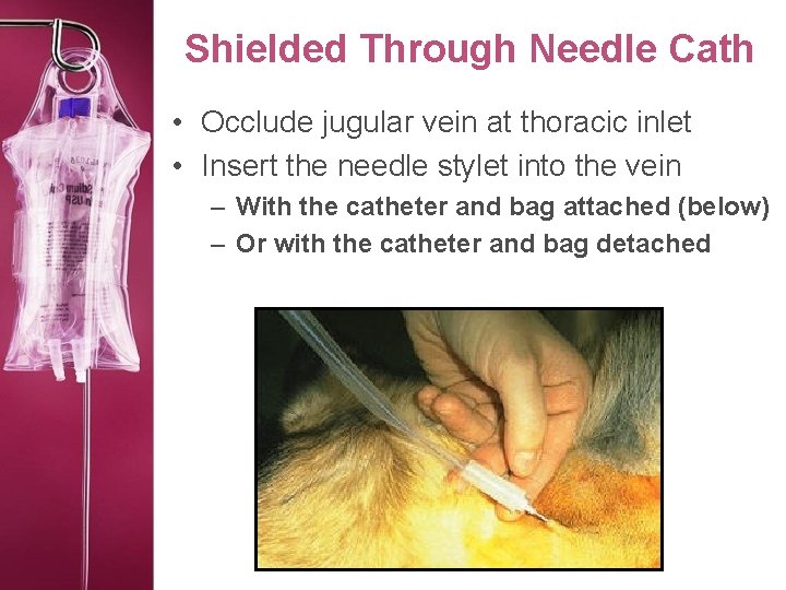 Shielded Through Needle Cath • Occlude jugular vein at thoracic inlet • Insert the