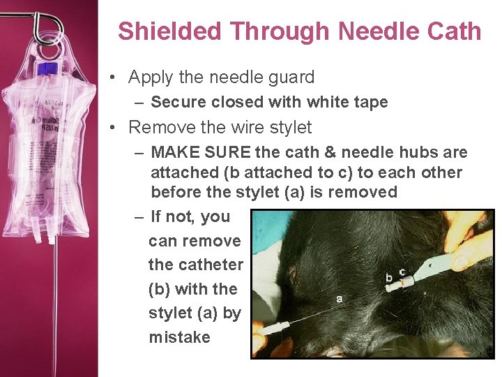 Shielded Through Needle Cath • Apply the needle guard – Secure closed with white