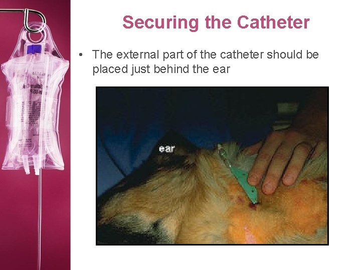 Securing the Catheter • The external part of the catheter should be placed just