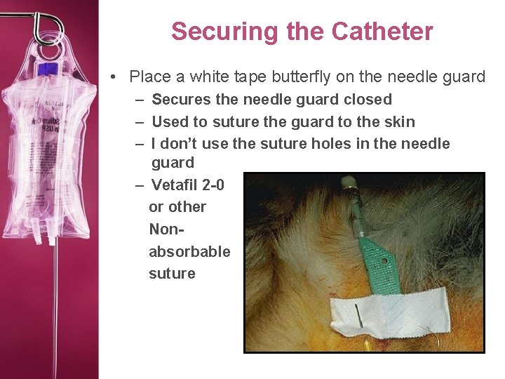Securing the Catheter • Place a white tape butterfly on the needle guard –