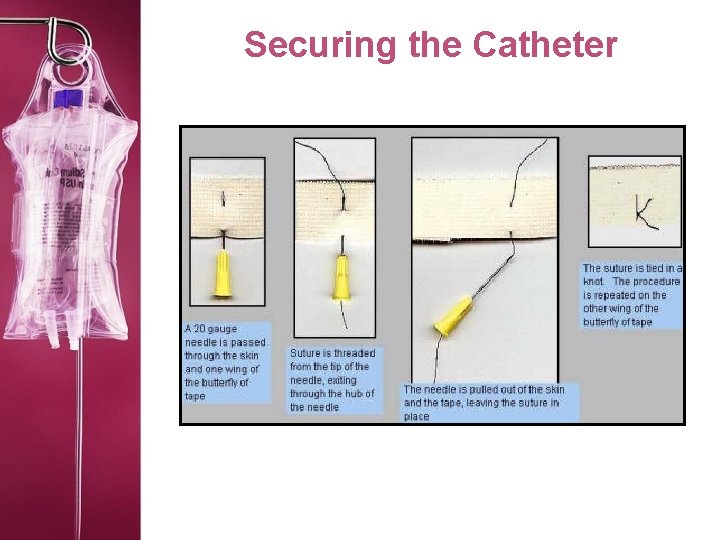 Securing the Catheter 