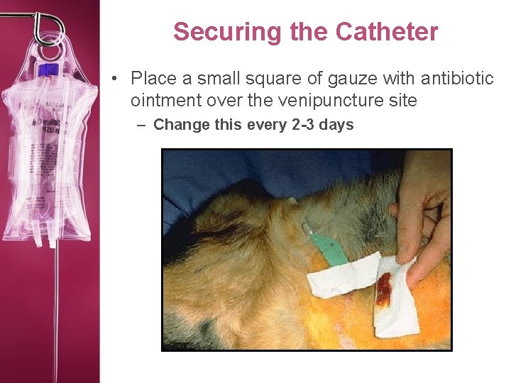 Securing the Catheter • Place a small square of gauze with antibiotic ointment over