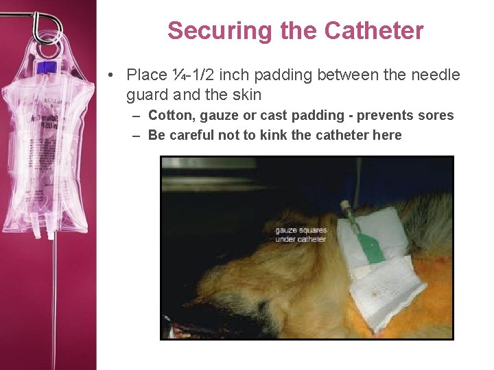 Securing the Catheter • Place ¼-1/2 inch padding between the needle guard and the