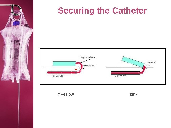 Securing the Catheter free flow kink 