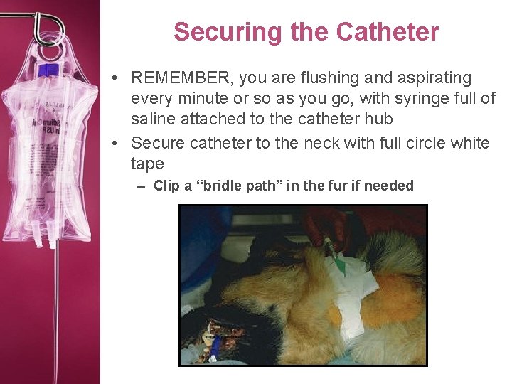 Securing the Catheter • REMEMBER, you are flushing and aspirating every minute or so