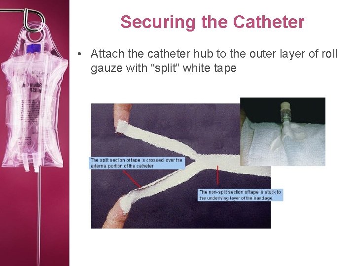 Securing the Catheter • Attach the catheter hub to the outer layer of roll