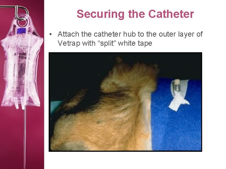 Securing the Catheter • Attach the catheter hub to the outer layer of Vetrap