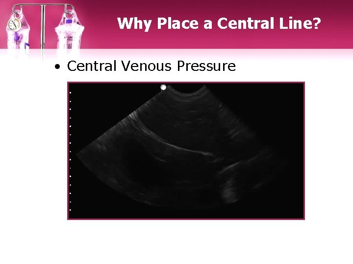 Why Place a Central Line? • Central Venous Pressure 