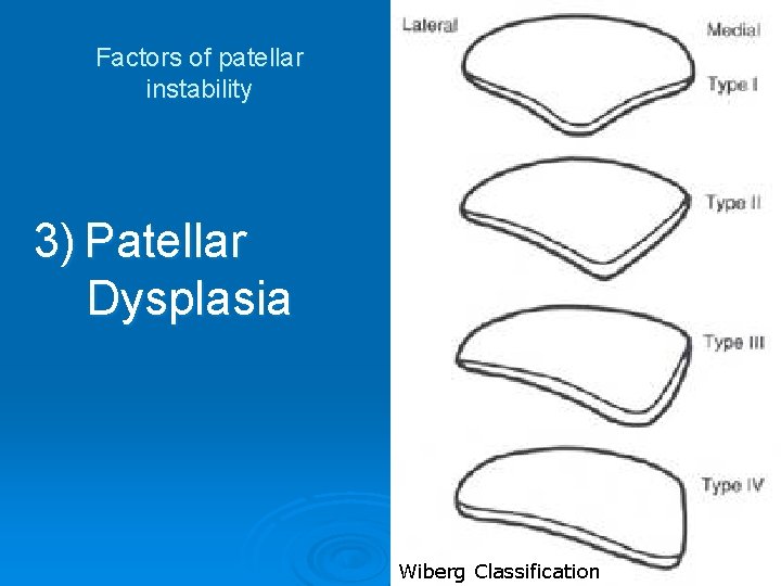 Factors of patellar instability 3) Patellar Dysplasia Wiberg Classification 