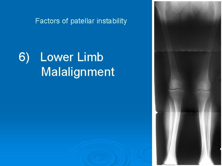 Factors of patellar instability 6) Lower Limb Malalignment 