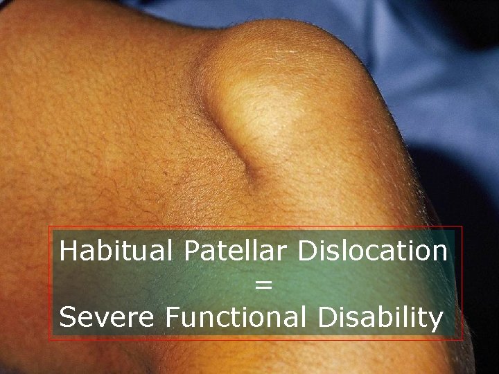 Habitual Patellar Dislocation = Severe Functional Disability 