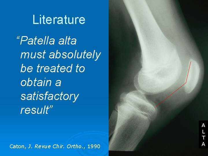 Literature “Patella alta must absolutely be treated to obtain a satisfactory result” Caton, J.