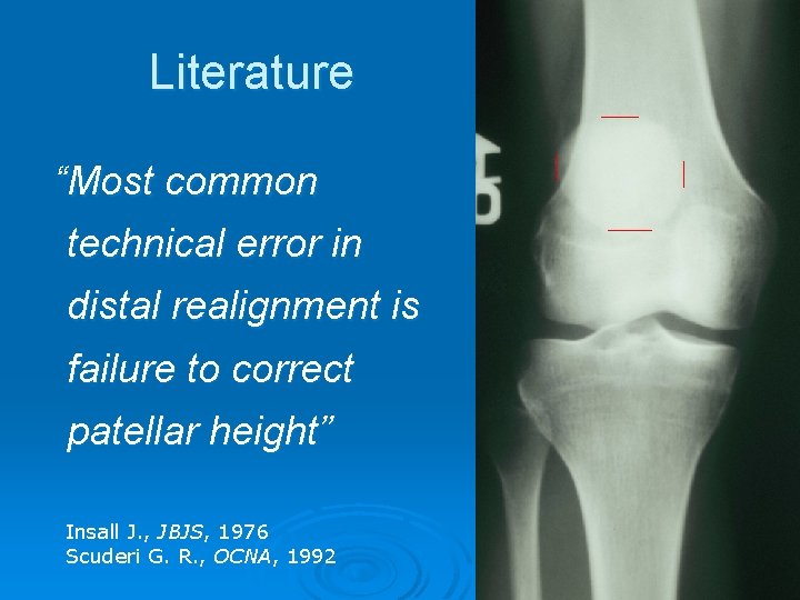 Literature “Most common technical error in distal realignment is failure to correct patellar height”
