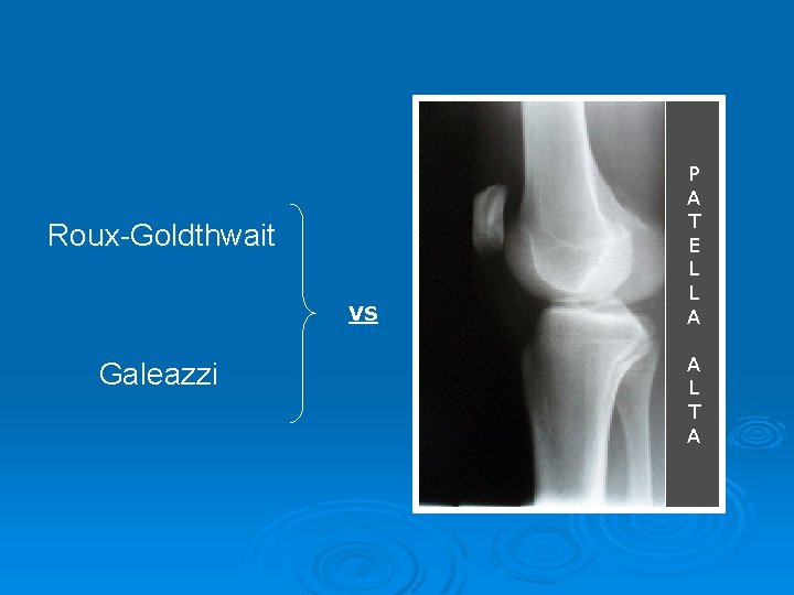 Roux-Goldthwait VS Galeazzi P A T E L L A A L T A Roux-Goldthwait VS Galeazzi P A T E L L A A L T A