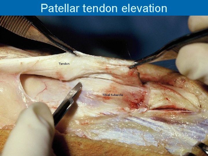 Patellar tendon elevation Tendon Tibial tubercle 