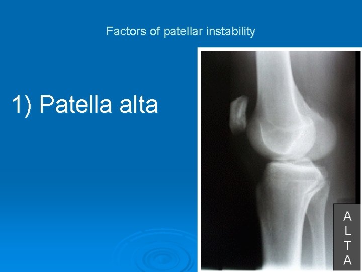 Factors of patellar instability 1) Patella alta A L T A 