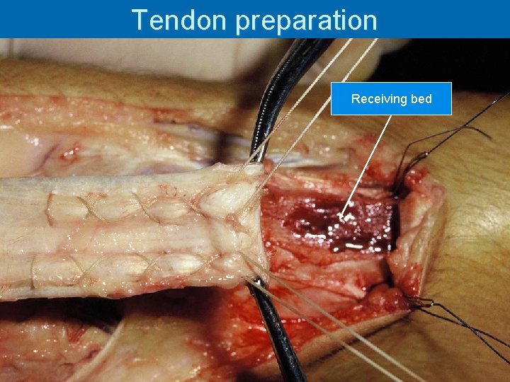 Tendon preparation Receiving bed Transosseous sutures 