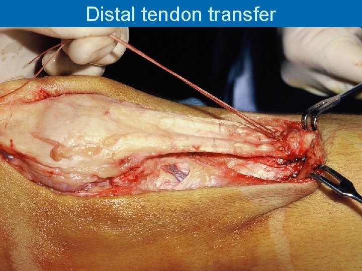 Distal tendon transfer 