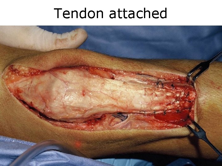 Tendon attached 
