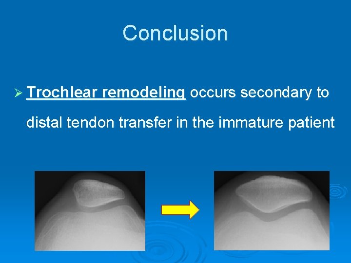 Conclusion Ø Trochlear remodeling occurs secondary to distal tendon transfer in the immature patient