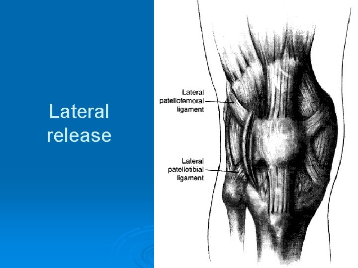Lateral release 