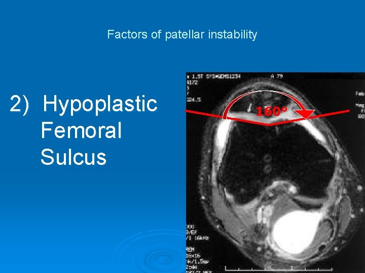 Factors of patellar instability 2) Hypoplastic Femoral Sulcus 160° 