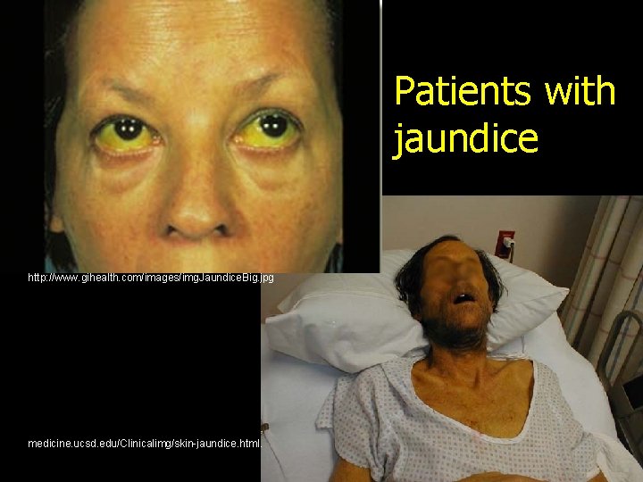 Patients with jaundice http: //www. gihealth. com/images/img. Jaundice. Big. jpg medicine. ucsd. edu/Clinicalimg/skin-jaundice. html.