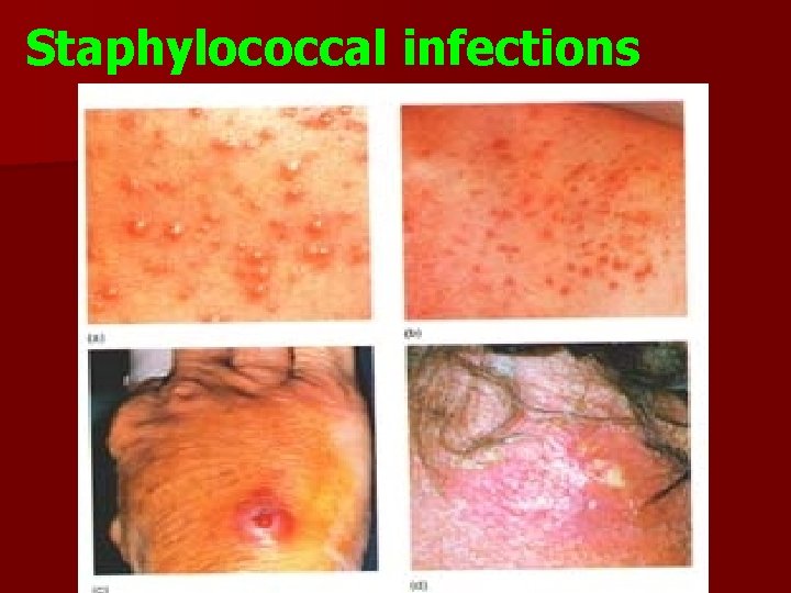 Staphylococcal infections 