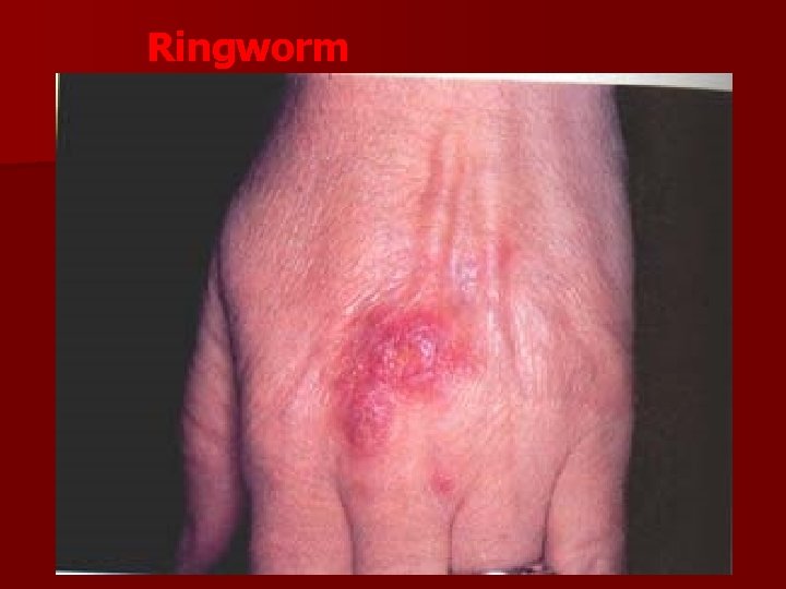 Ringworm 