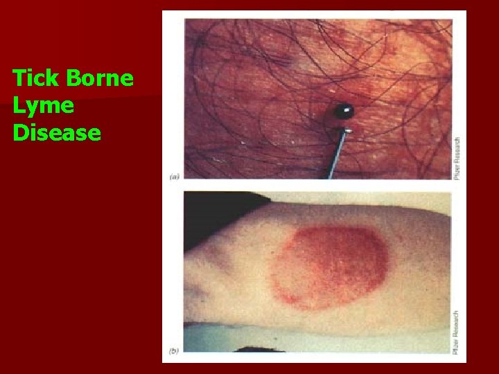 Tick Borne Lyme Disease 