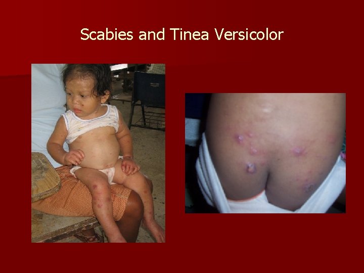 Scabies and Tinea Versicolor 