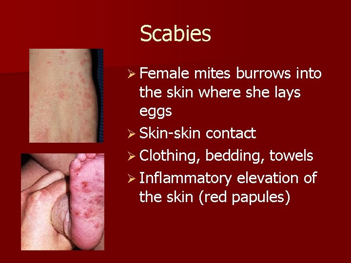 Scabies Ø Female mites burrows into the skin where she lays eggs Ø Skin-skin