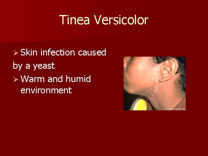 Tinea Versicolor Ø Skin infection caused by a yeast Ø Warm and humid environment