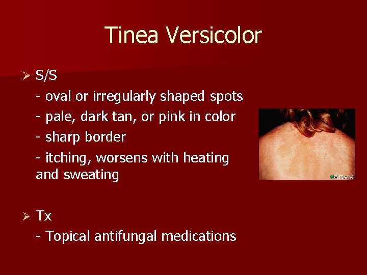 Tinea Versicolor Ø S/S - oval or irregularly shaped spots - pale, dark tan,