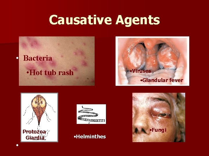 Causative Agents • Bacteria • Viruses • Hot tub rash • Protozoa Giardia •