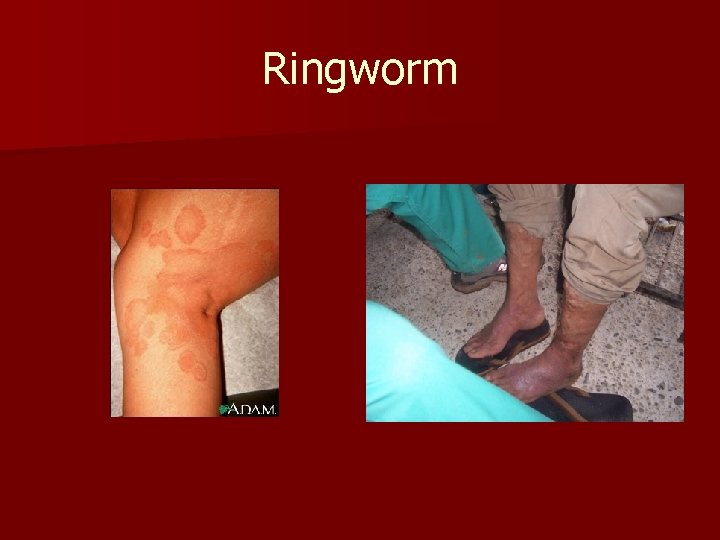 Ringworm 