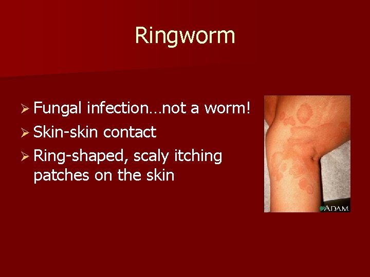 Ringworm Ø Fungal infection…not a worm! Ø Skin-skin contact Ø Ring-shaped, scaly itching patches