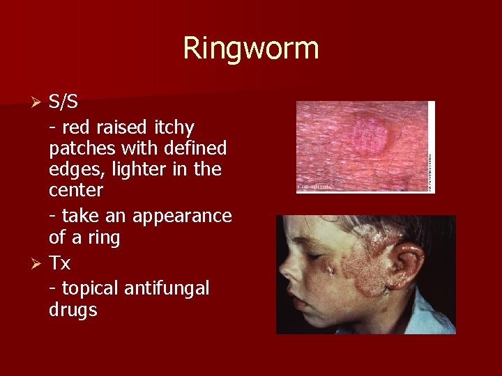 Ringworm S/S - red raised itchy patches with defined edges, lighter in the center