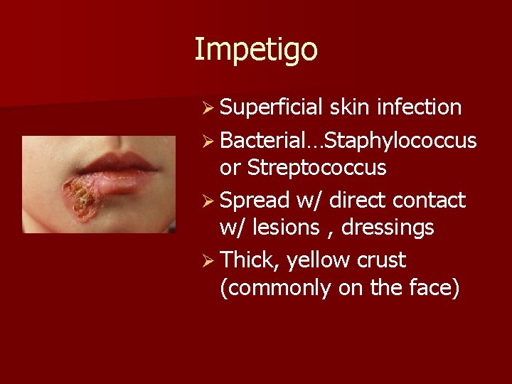 Impetigo Ø Superficial skin infection Ø Bacterial…Staphylococcus or Streptococcus Ø Spread w/ direct contact