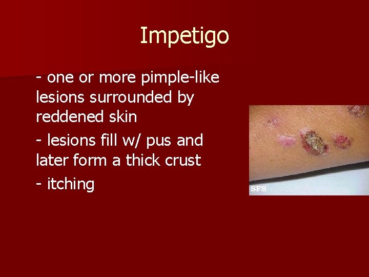 Impetigo - one or more pimple-like lesions surrounded by reddened skin - lesions fill