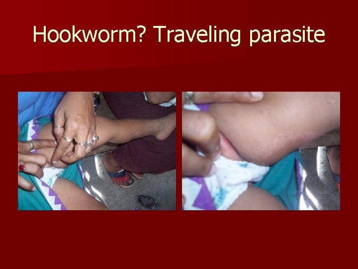 Hookworm? Traveling parasite 