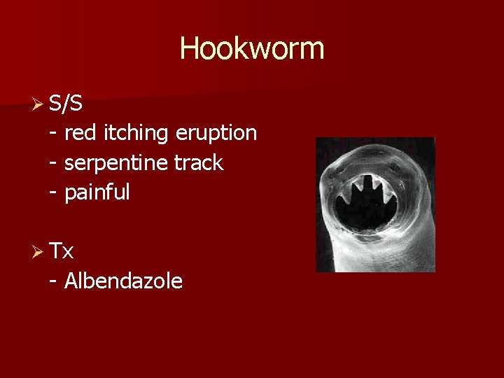 Hookworm Ø S/S - red itching eruption - serpentine track - painful Ø Tx
