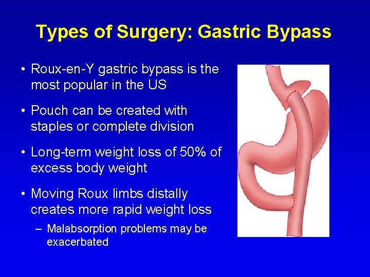 Types of Surgery: Gastric Bypass • Roux-en-Y gastric bypass is the most popular in