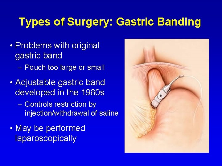 Types of Surgery: Gastric Banding • Problems with original gastric band – Pouch too